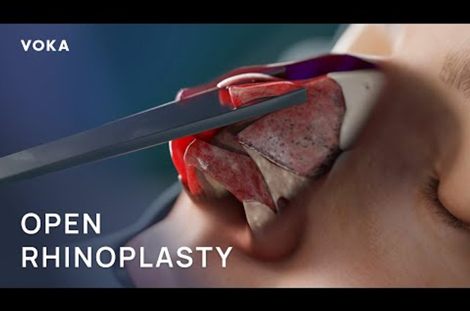 What Really Happens During Rhinoplasty by VOKA 3D Anatomy & Pathology